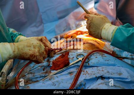 Beating human heart in opened chest during the surgery chest during heart surgery Stock Photo