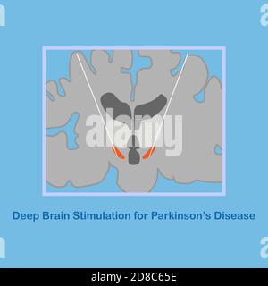 Deep brain stimulation at subthalamic nucleus for treatment of ...