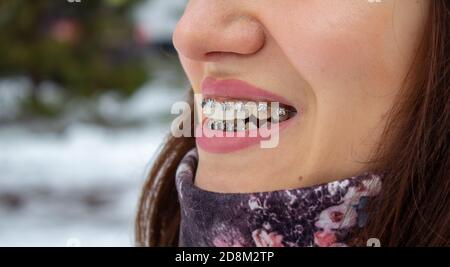 brasket system in smiling mouth, macro photo teeth, close-up lips,  Stock Photo