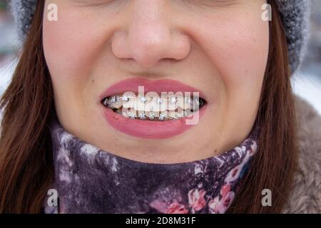 brasket system in smiling mouth, macro photo teeth, close-up lips,  Stock Photo