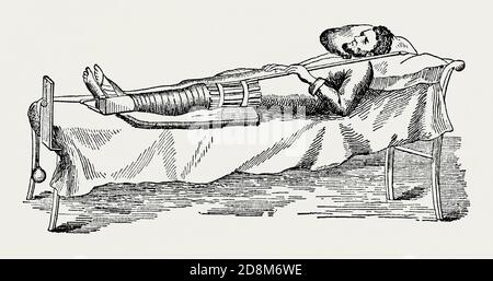 An old engraving of a man being treated for a broken leg (femur) in the 1800s. It is from a Victorian mechanical engineering book of the 1880s. The illustration shows the man lying on a bed. His leg is bandaged and a splint surrounds the upper leg. A weight and pulley system at the base of the bed (counter-extension apparatus) is attached to the foot, helping to extend the limb – allowing the bones fuse without shortening the leg. Wrapping the bone in plaster began in the 1700s. Limbs were often put in traction, pulling the bone back into place, before being set. Stock Photo