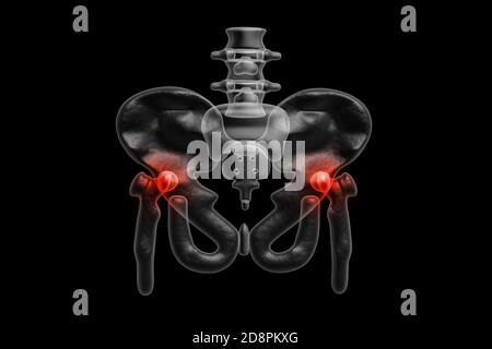 3d Painful hip in black background Stock Photo