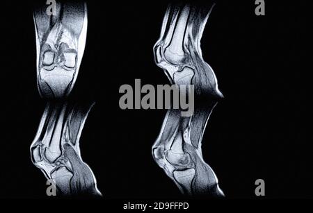 Magnetic resonance imaging or MRI of knee joint sagittal PDW for detect ...
