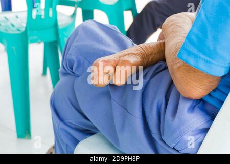 closeup hand of old asian man suffering from leprosy, amputated hand Stock Photo