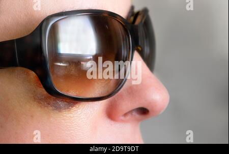 abused woman hides her black eye behind sunglasses, gender violence close up Stock Photo