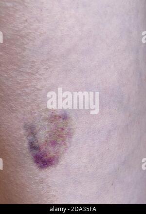 Bruise, hematoma on the human body. Large bruise, bruise on the stomach ...