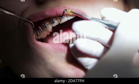 Young woman dentist. Replacement of elastic bands on braces. Mouth close-up. Stock Photo