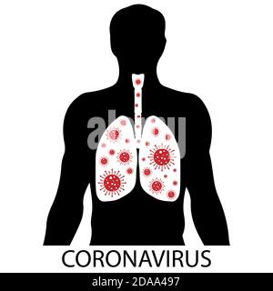 Virus quarantine. MERS-Cov middle East respiratory syndrome. Human lungs infected with the virus. Respiratory system. Disease within a person Stock Vector