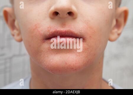 Atopic skin on the boy face. Human skin, presenting an allergic reaction, allergic rash on face and lips. Health care and medicine concept. Stock Photo