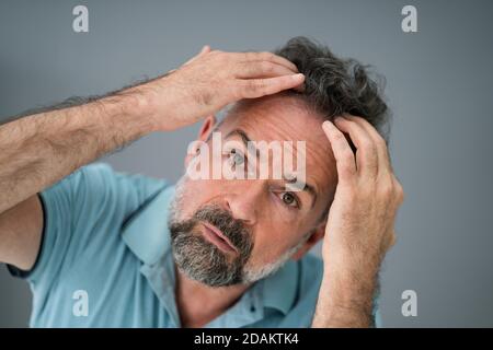 Man Checking His Hair Loss And Dandruff Stock Photo
