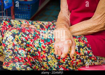closeup hands of old woman suffering from leprosy, amputated hands Stock Photo
