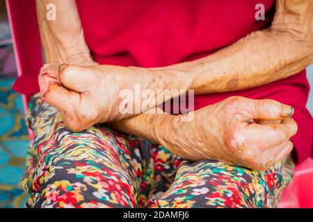 closeup hands of old woman suffering from leprosy, amputated hands Stock Photo