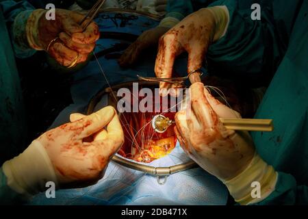 Surgeon doctors perform on open heart valve replacement surgery. Stock Photo