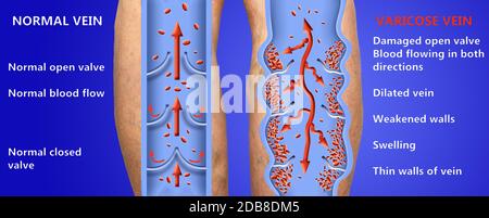 Varicose veins on a female senior legs. The structure of normal and varicose veins. Concept of dry skin, old senior people, varicose veins and deep ve Stock Photo