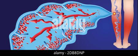 Varicose veins on a female senior legs. The structure of vein. DVT Stock Photo