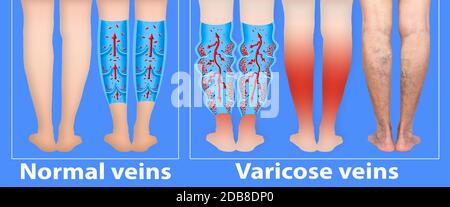 Varicose veins on a female senior legs. The structure of normal and varicose veins. Concept of dry skin, old senior people, varicose veins and deep ve Stock Photo