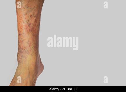 Varicose veins affecting the leg of an elderly man - Stock Image -  M290/0099 - Science Photo Library