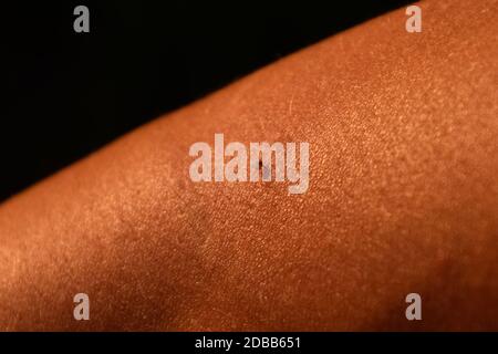 Bee sting. Bee sting in human skin. The consequences of stinging with bee venom. Stock Photo