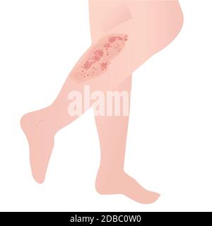 Illustration of psoriasis skin disease Stock Photo - Alamy