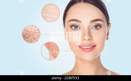 Female face close-up, show skin problems. Dry skin, acne, wrinkles, and other imperfections. On blue background Stock Photo