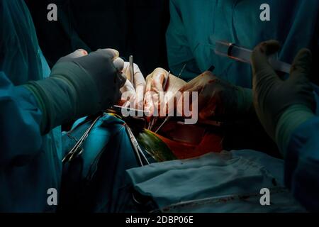 Suture of an lung emphysema surgery in an infant andmedical assistance close-up Stock Photo