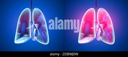 3D rendered illustration of healthy and infected lungs in comparison. Stock Photo