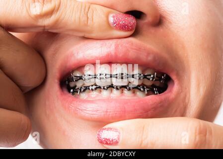 Close up detail macro of young Asian woman smile show mouth with white teeth with black brackets braces, studio shot isolated on white background, Hea Stock Photo