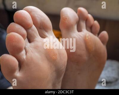 Close up of Calluses. Painful corn on foot. Stock Photo