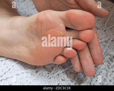 Close up of Calluses. Painful corn on foot. Stock Photo