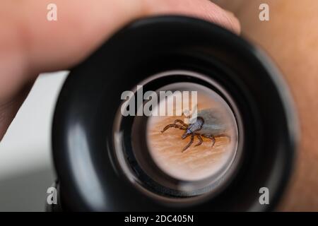 Deer tick on human skin in magnifying glass of black eyepiece. Ixodes ricinus. Small parasitic mite detail zoomed in by magnifier. Tickborne  diseases. Stock Photo