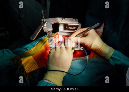 Teamwork surgeons during open heart surgery doctor holding surgical instruments during medical procedure at clinic Stock Photo
