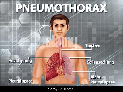 Human anatomy Pneumothorax diagram illustration Stock Vector