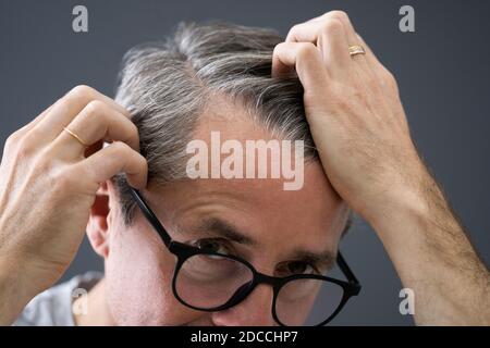 Balding Man Losing Hair. Checking Scalp Hair Loss Stock Photo