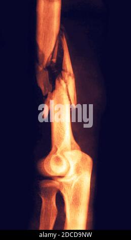 Bone Fracture, X-Ray, First World War Stock Photo