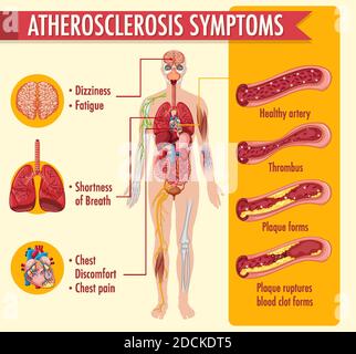 Stages of atherosclerosis information infographic illustration Stock ...