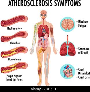 Stages of atherosclerosis information infographic illustration Stock ...