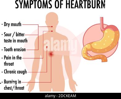 heartburn location