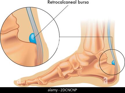 Illustration showing the position of the retrocalcaneal bursa in the foot, with an enlarged detail, and annotation. Stock Vector