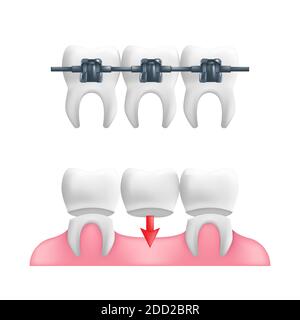 Denture concept - healthy teeth with a fixed dental bridgework and braces on top of them. Vector illustration of human teeth in a 3d realistic style i Stock Vector