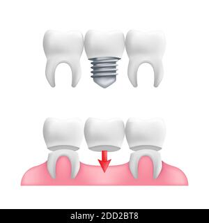 Denture concept - healthy teeth with fixed dental bridgework and implants. Vector illustration of human teeth in a 3d realistic style isolated on a wh Stock Vector