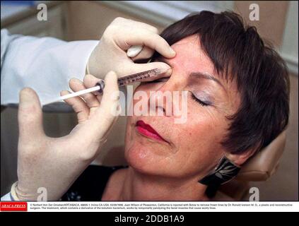 NO FILM, NO VIDEO, NO TV, NO DOCUMENTARY - © Norbert Von Der Groeben/KRT/ABACA. 48835-1. Irvine-CA-USA. 03/09/1998. Jean Wilson of Pleasanton, California is injected with Botox to remove frown lines by Dr. Ronald Iverson M. D., a plastic and reconstructive surgeon. The treatment, which contains a Stock Photo