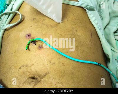 Close up tube radivac drain on man patient stomach lying in hospital bed Stock Photo