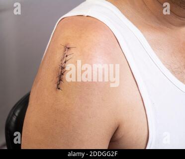 Front side closeup view of surgical incision on upper right shoulder joint closed with sutures Stock Photo