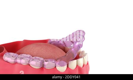 silicone braces on the display stand 3d render on white Stock Photo