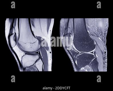 Magnetic resonance imaging or MRI knee comparison Coronal view for ...