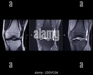 Magnetic resonance imaging of the knee or MRI knee coronal view for ...