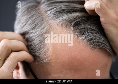 Balding Man Losing Hair Stock Photo - Alamy