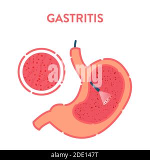 Gastroscopy, illustration Stock Photo