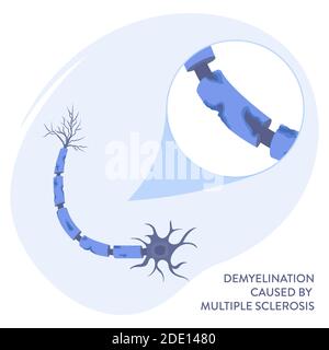 Multiple sclerosis, illustration Stock Photo
