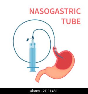 Nasogastric feeding tube, illustration Stock Photo